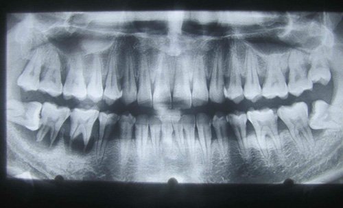 răng, răng khôn, răng số 8, nhổ răng khôn, nhổ răng số 8, răng mọc lệch, răng hàm mặt